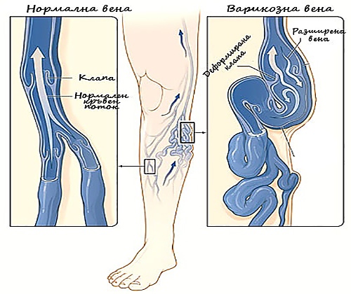 Съвети при разширени вени