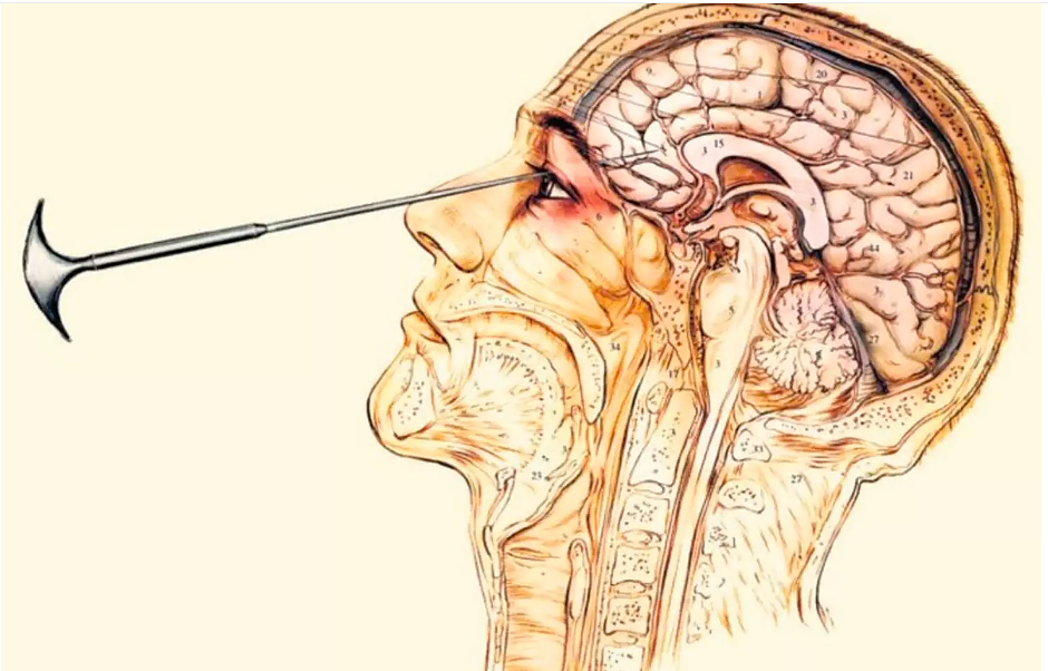 Варварство в името на науката: Какво не знаете за лоботомията
