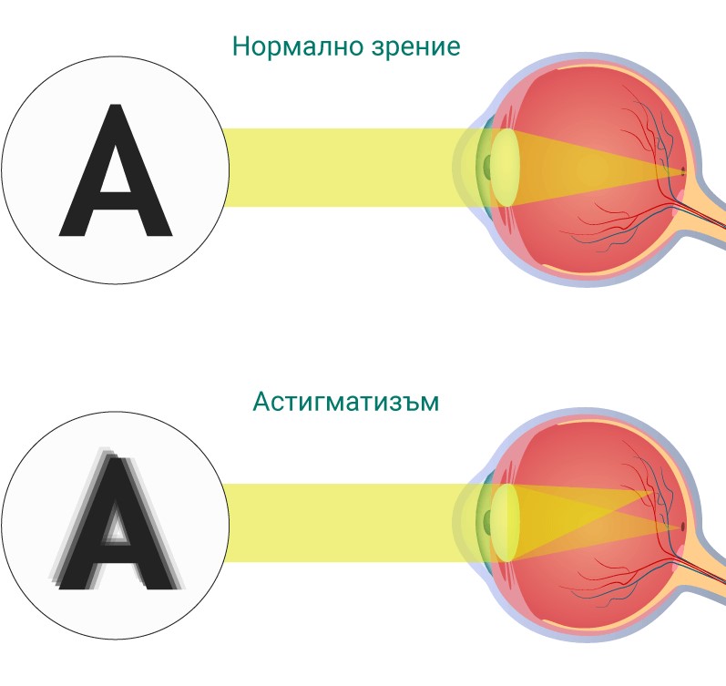 Астигматизъм